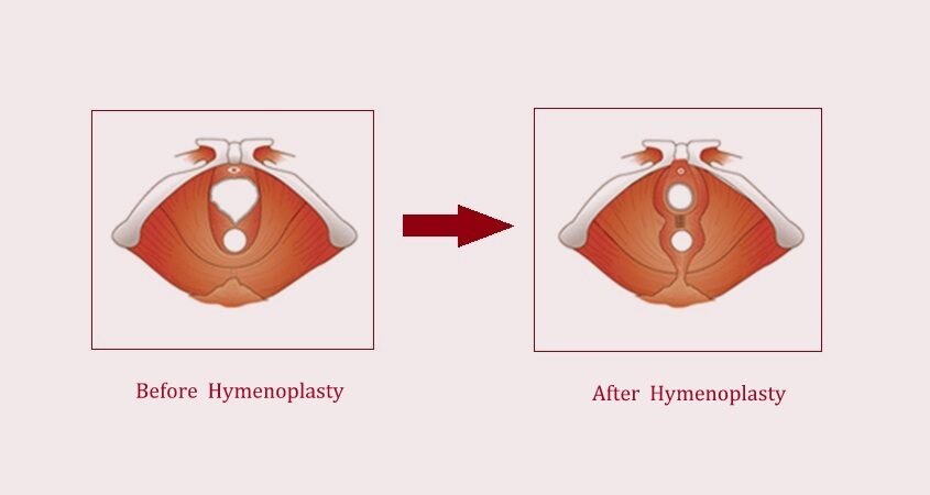 Hymenoplasty before after
