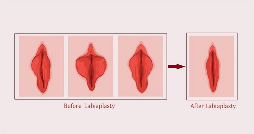 labiaplasty Surgery in Mumbai