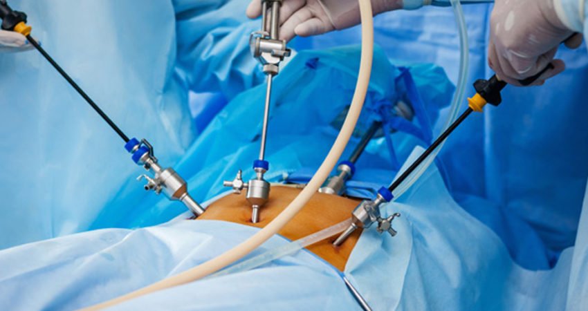 laparoscopic-surgery