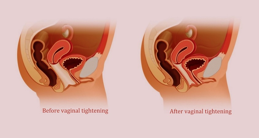 vaginal tightening before after